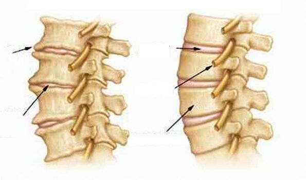 Kas ir osteohondroze