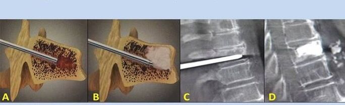 punkcijas vertebroplastika muguras sāpēm