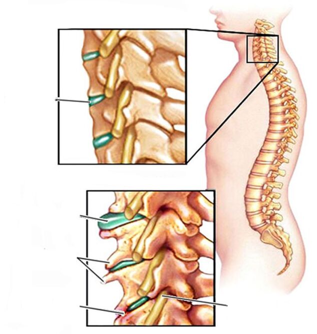 osteohondroze un veselīga mugurkaula kakla daļa