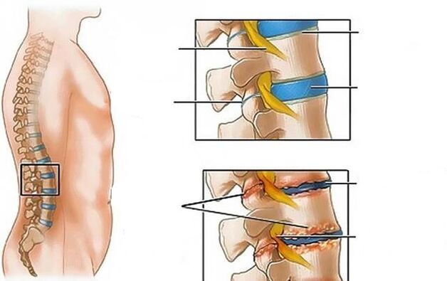 mugurkaula jostas daļas osteohondroze izraisa muguras sāpes